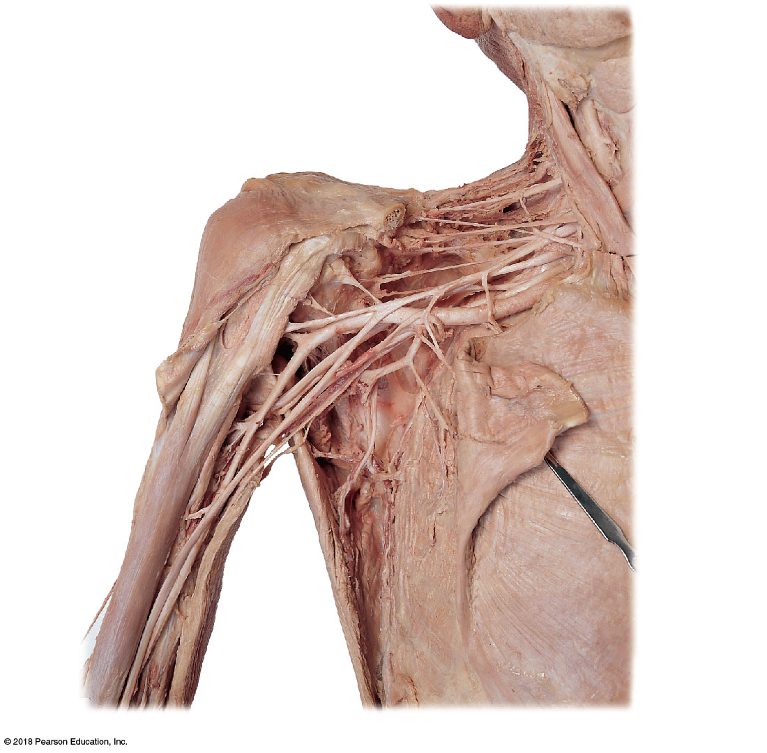 Dissection of the neck and shoulder showing the brachial plexus