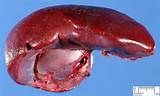 The spleen: intraperitoneal LUQ organ against ribs 9–11, with white pulp (lymphatic) and red pulp (blood filtration).