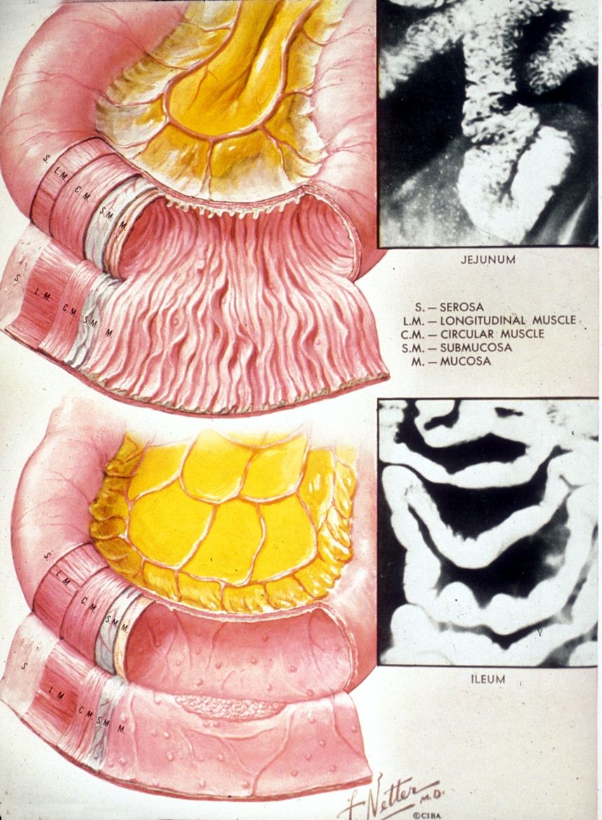 Terminal ileum with Peyer's patches, ending at the ileocecal junction.