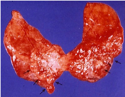 Parathyroid histology: chief cells (PTH) and larger eosinophilic oxyphil cells.