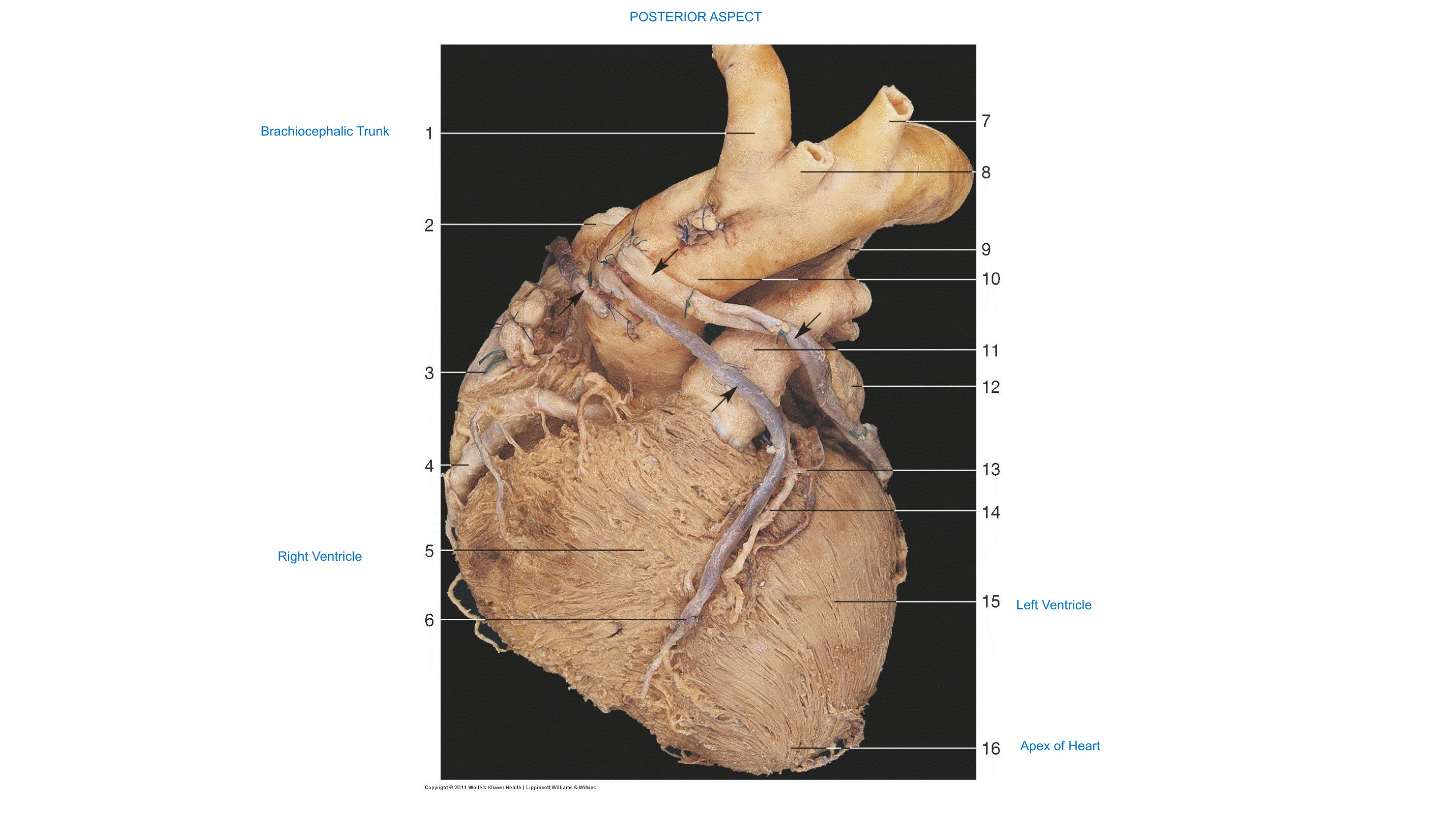 Great Vessels of the Heart (Posterior Aspect), fully labeled