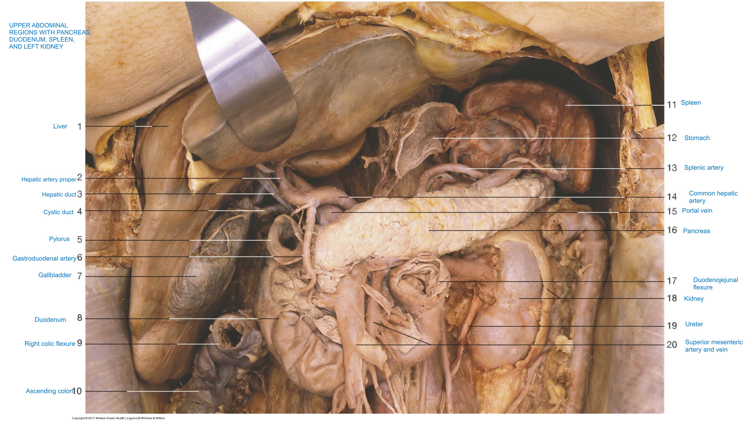 Upper Abdominal Regions — Pancreas, Duodenum, Spleen, Left Kidney, fully labeled