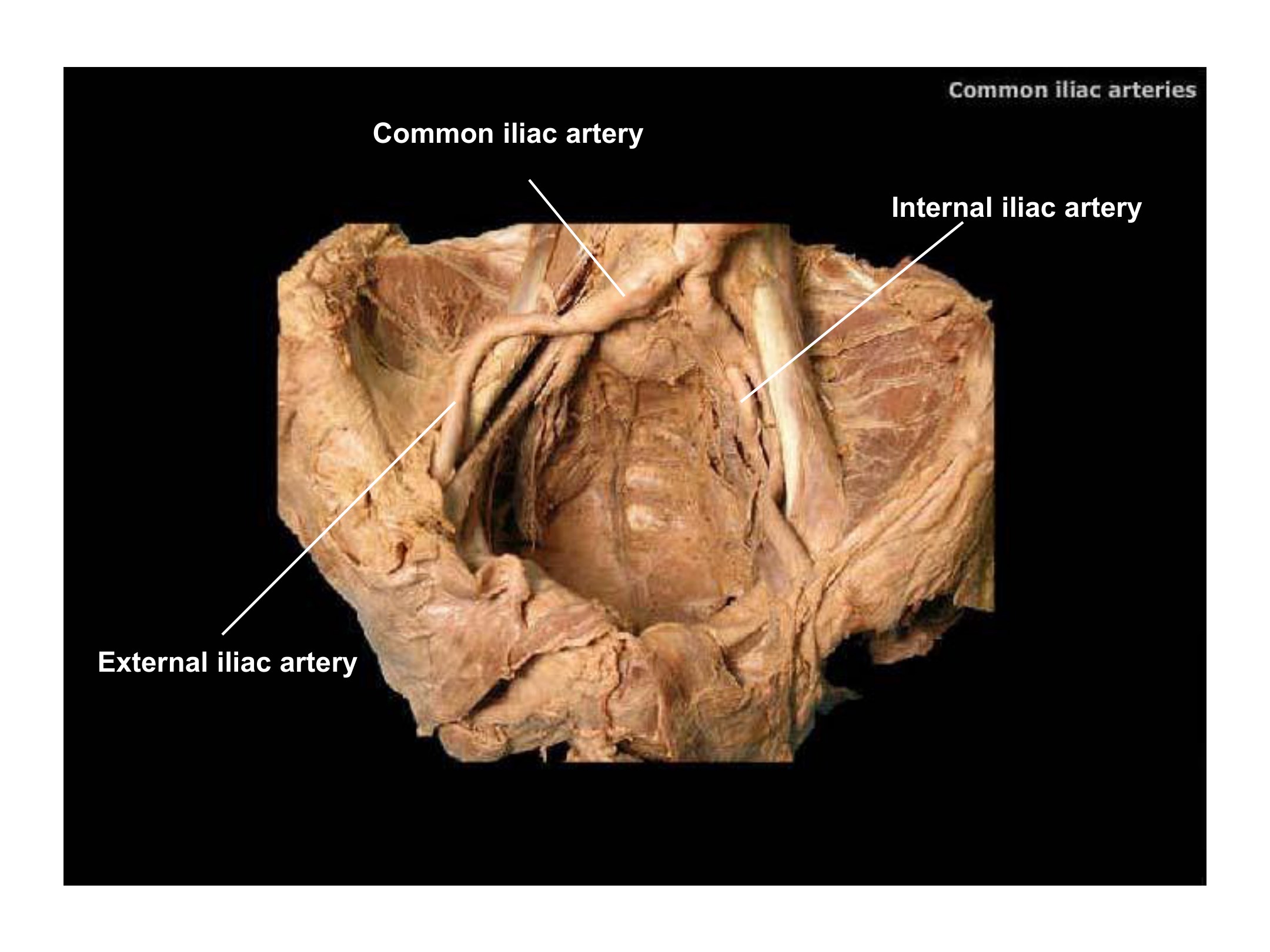 Common Iliac Arteries, fully labeled