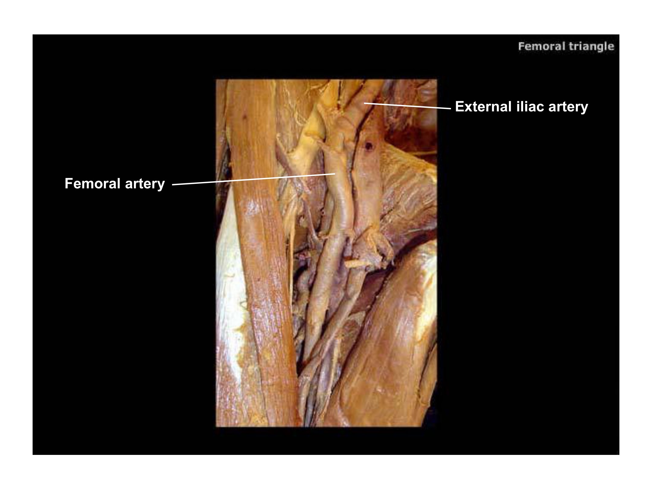 Femoral Triangle, fully labeled