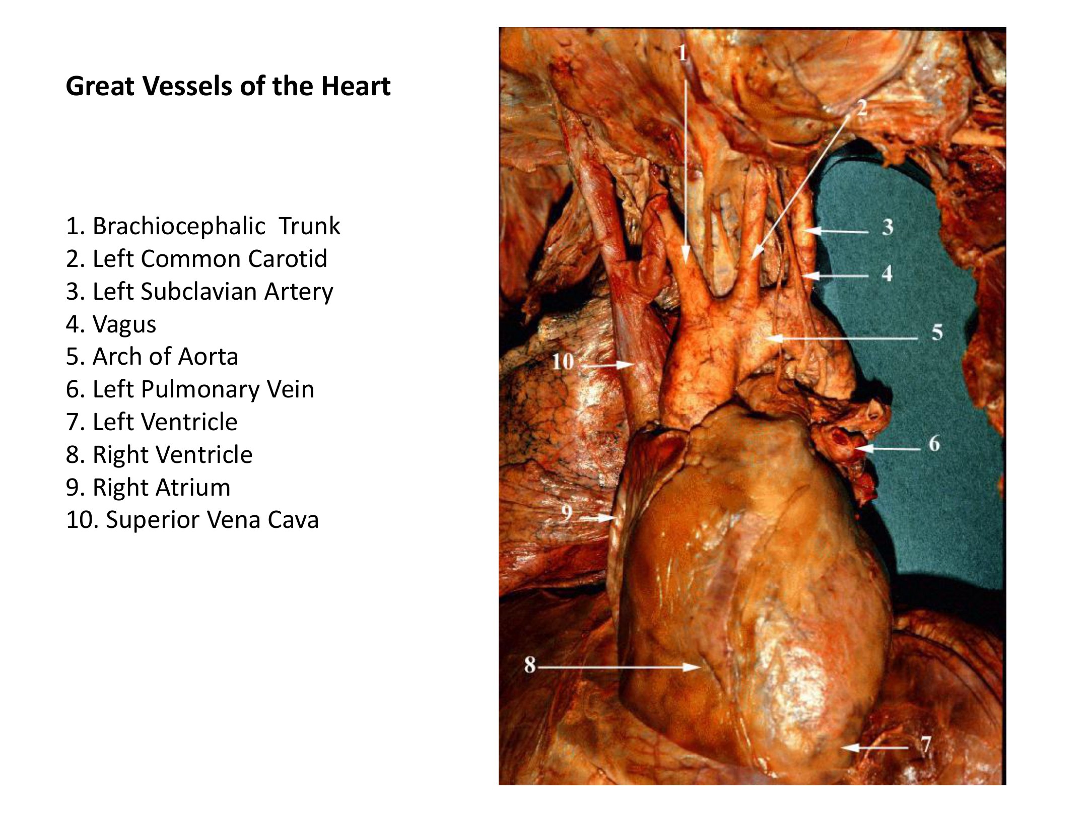 Great Vessels of the Heart, fully labeled