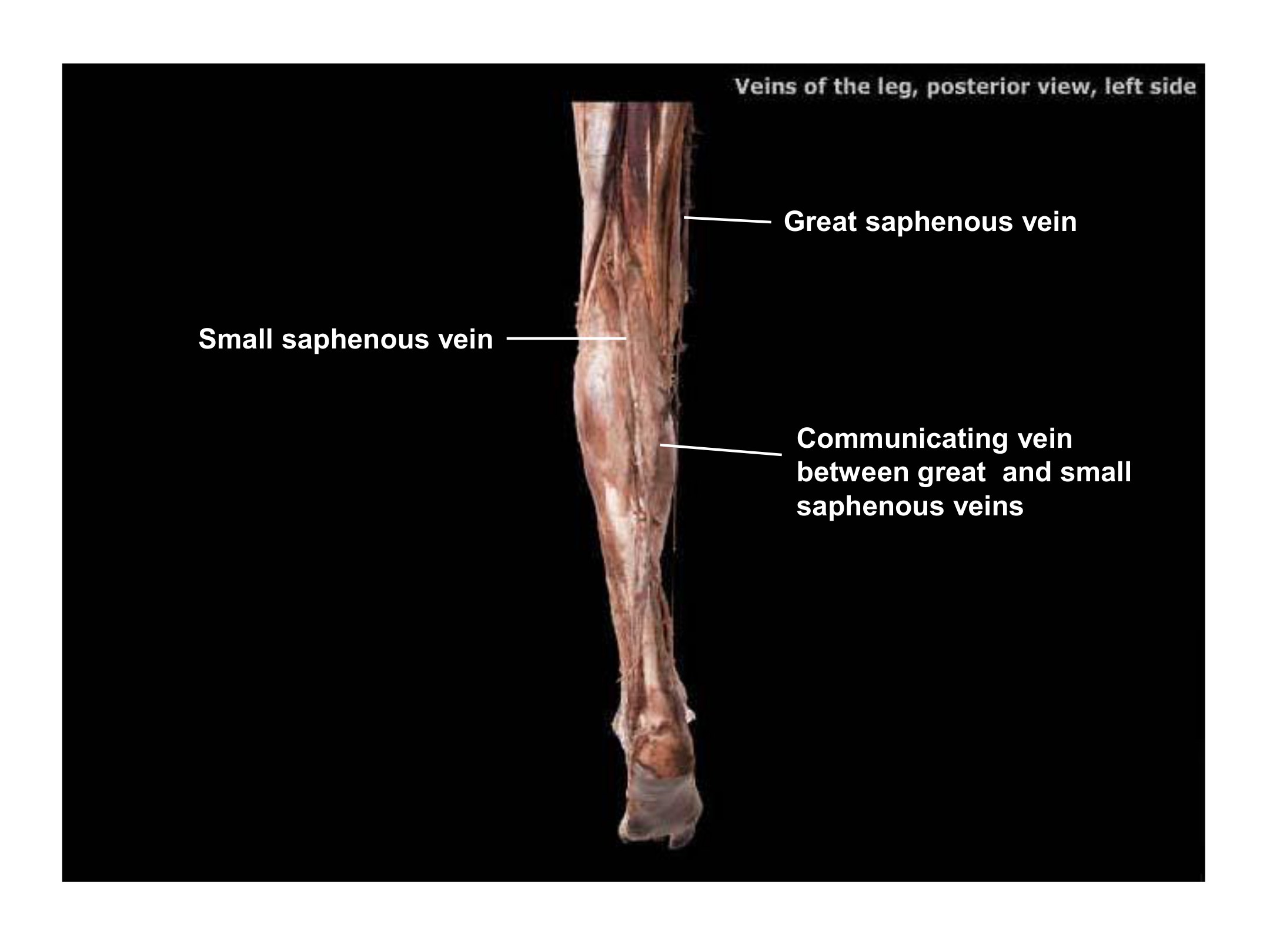 Veins of the Leg (Posterior View, Left Side), fully labeled