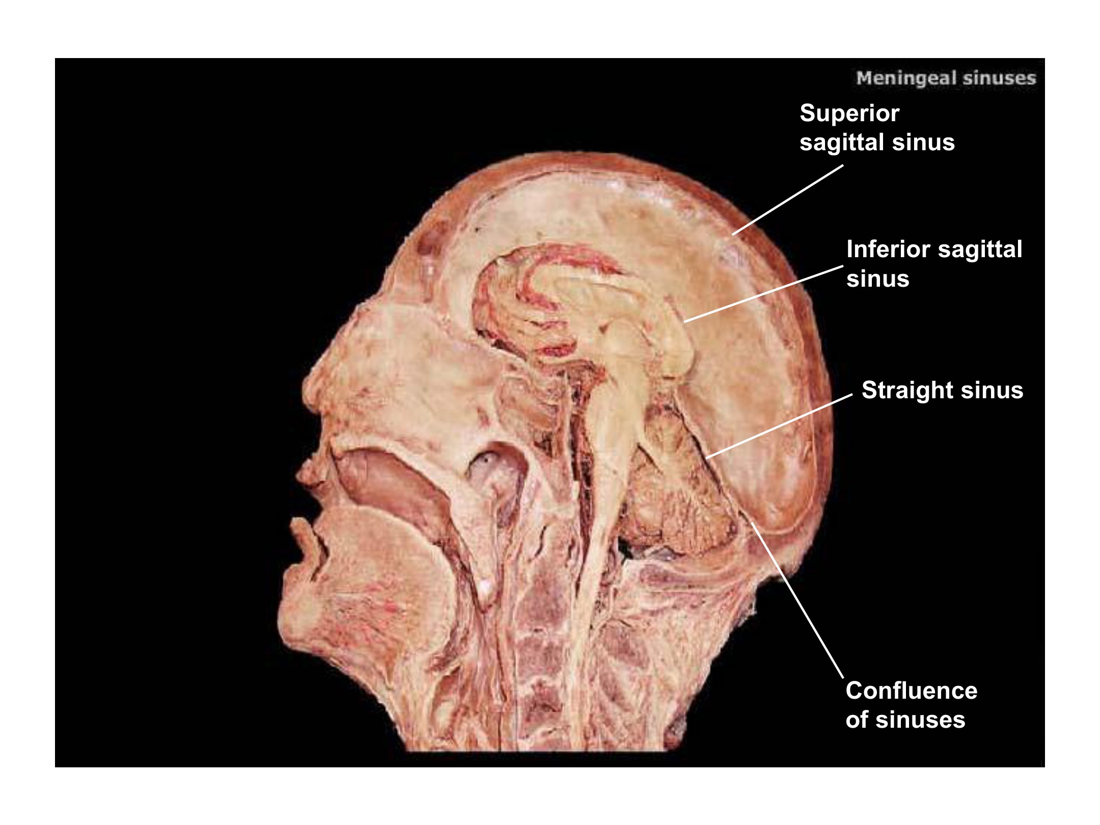 Meningeal Sinuses (Sagittal Section), fully labeled