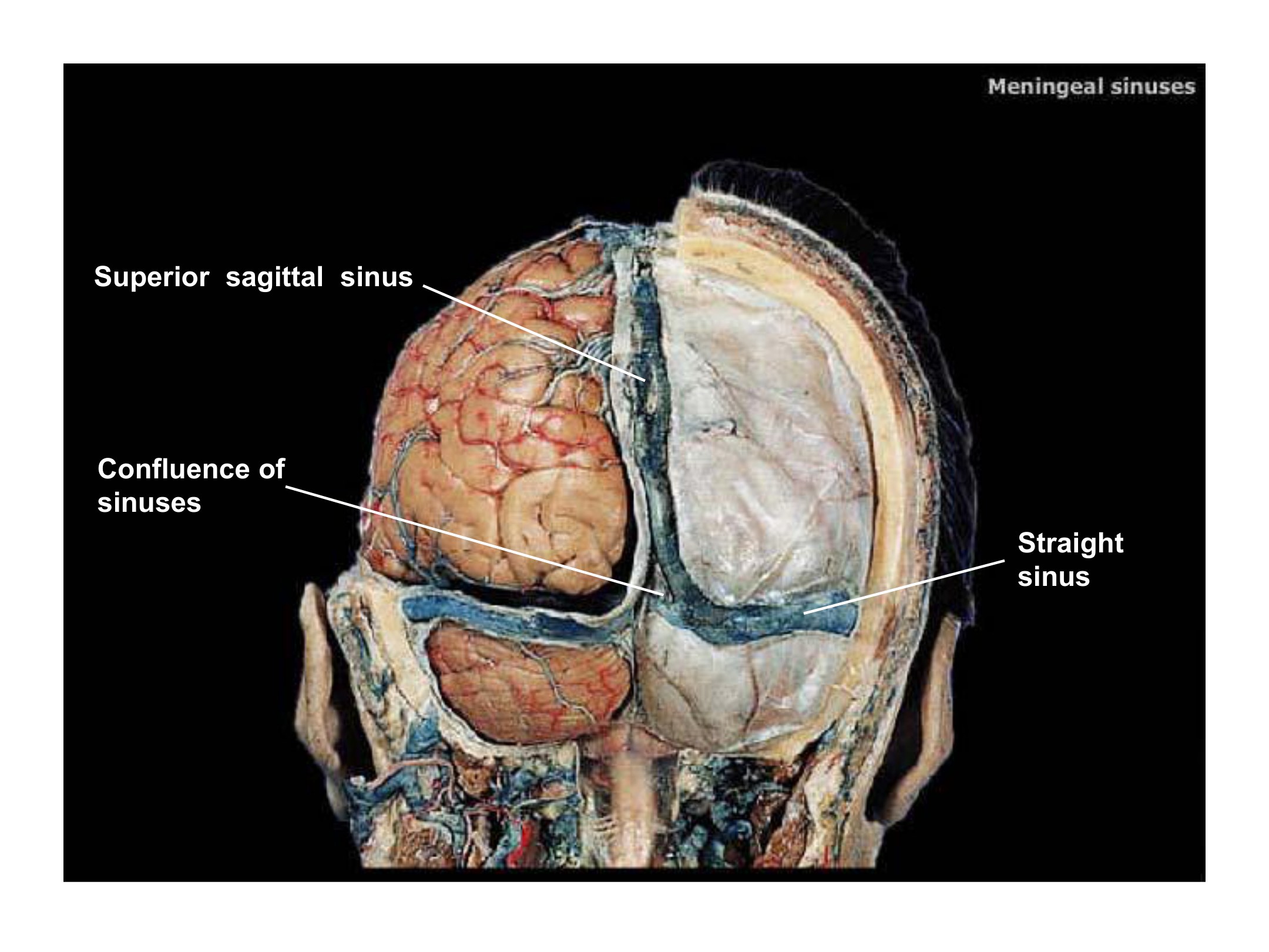 Meningeal Sinuses (Coronal Section), fully labeled