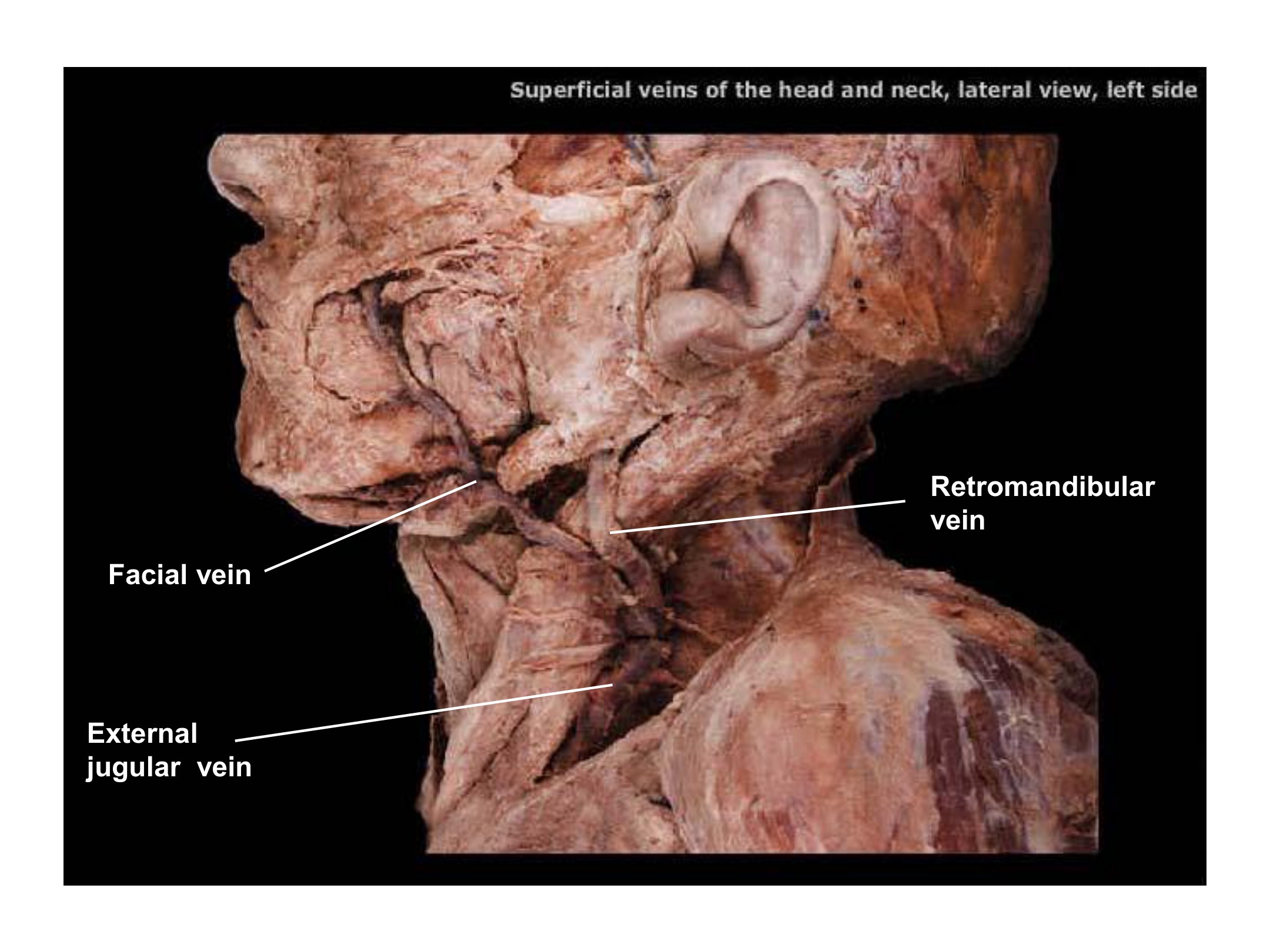 Superficial Veins of the Head and Neck, fully labeled