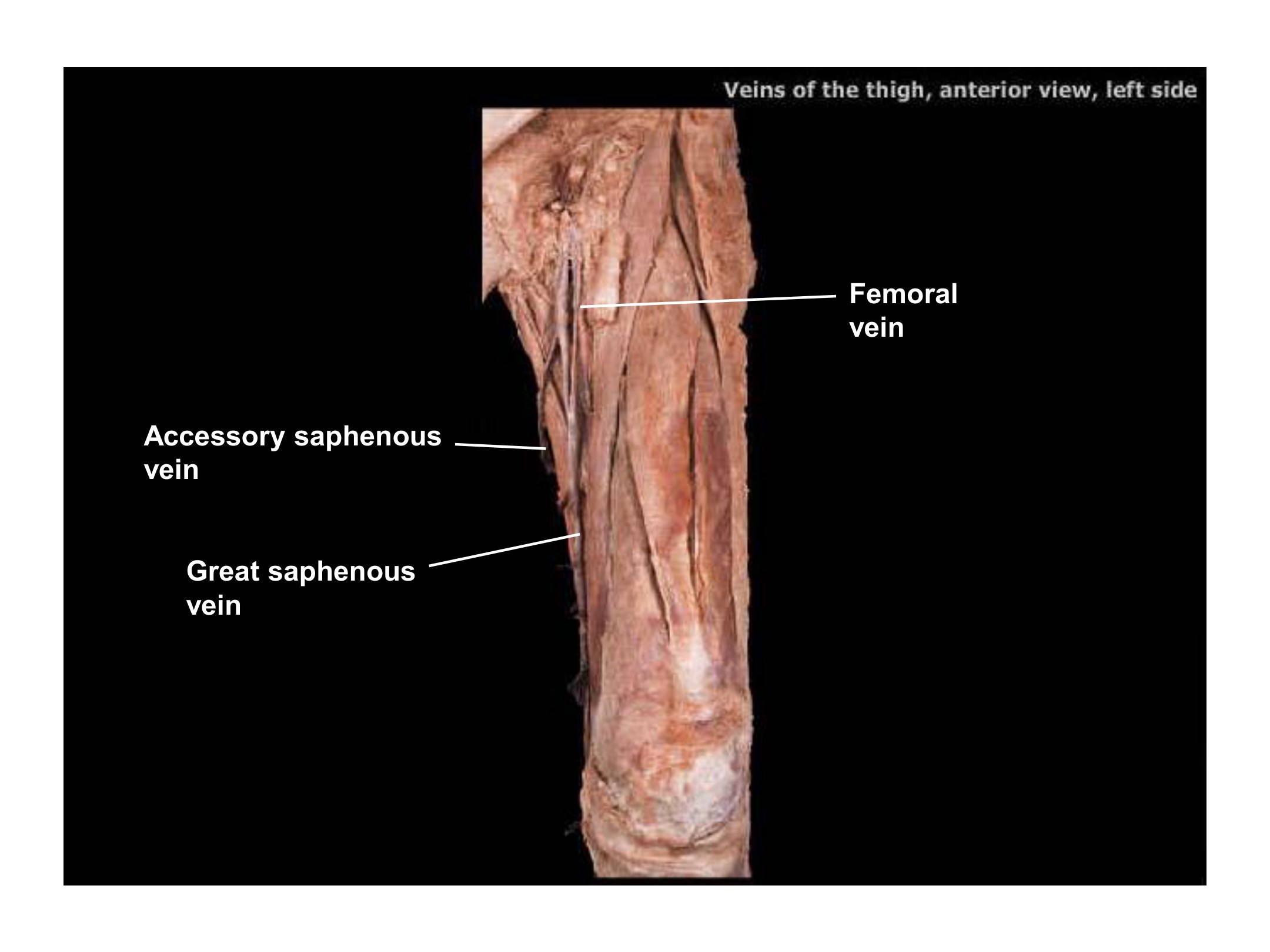 Veins of the Thigh (Anterior View, Left Side), fully labeled