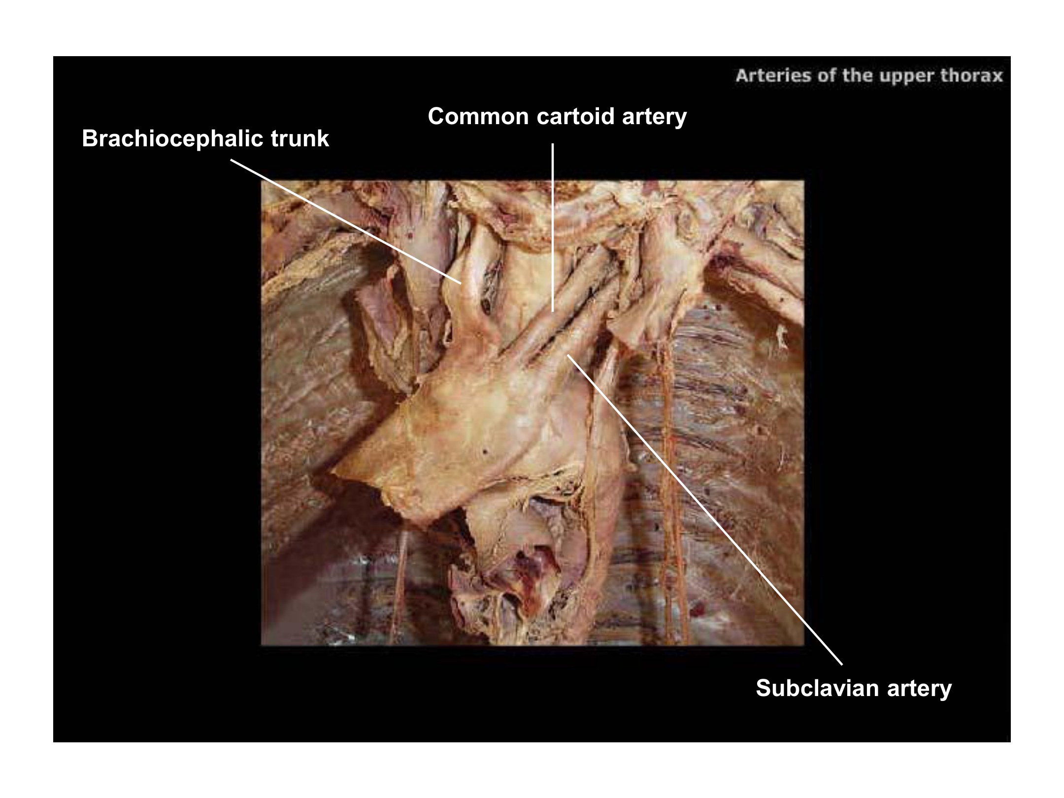 Arteries of the Upper Thorax, fully labeled