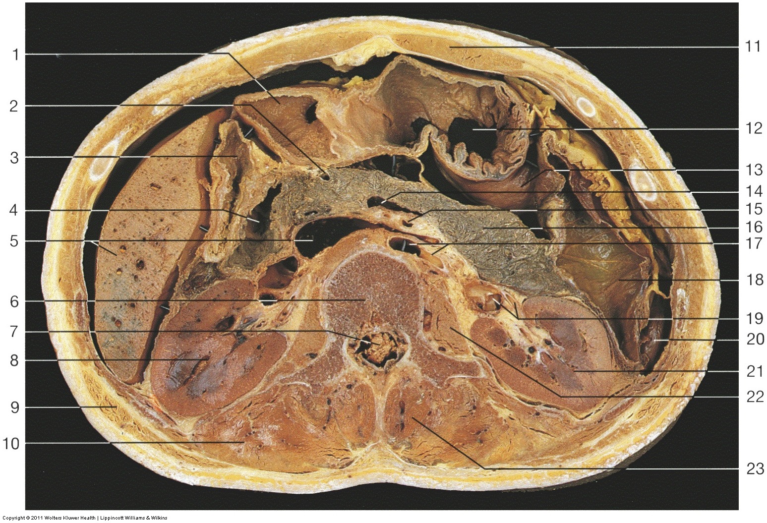 Kidney & Urinary Tract — Body of first lumbar vertebra (Lab 2, Slide 3), fully labeled