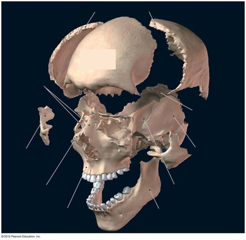 Skull — Bone Identification — Right Parietal bone, fully labeled