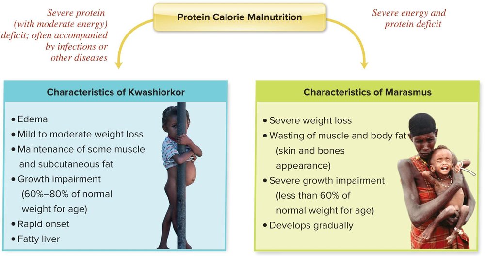 Comparison of the characteristics of Kwashiorkor and Marasmus: Kwashiorkor shows edema, wasting of muscle and body fat masked by fluid retention, and growth impairment 60%-80% of normal weight for age; Marasmus shows severe growth impairment less than 60% of normal weight for age, rapid onset, and flat/dry hair.
