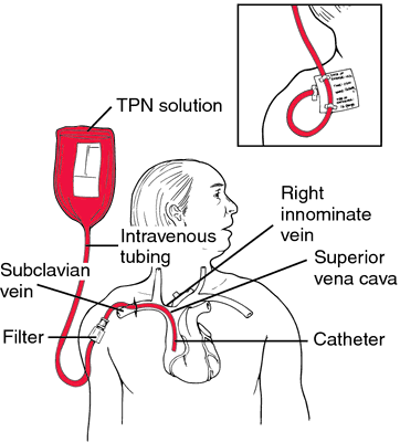 Diagram of a TPN (total parenteral nutrition) central line: the TPN solution bag connects via intravenous tubing and a filter to a catheter inserted through the subclavian vein, threading through the right innominate vein to terminate in the superior vena cava.