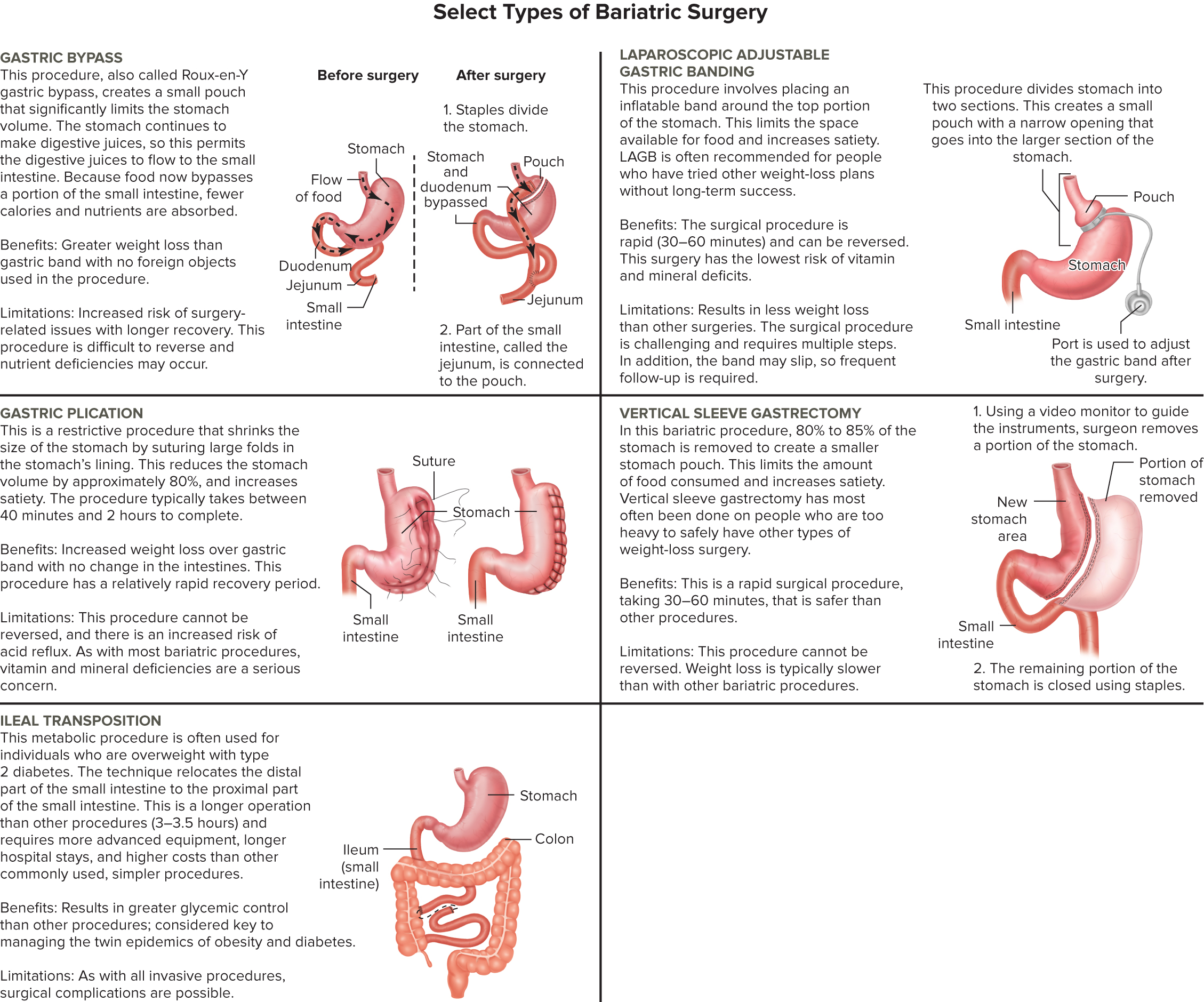 Diagram comparing five bariatric surgery types: gastric bypass (staples divide the stomach, small intestine rerouted to a new pouch), laparoscopic adjustable gastric banding (inflatable band around upper stomach with an adjustable port), gastric plication (large folds sutured to shrink stomach volume), vertical sleeve gastrectomy (80-85% of stomach removed to leave a narrow sleeve), and ileal transposition (distal small intestine relocated to the proximal small intestine).