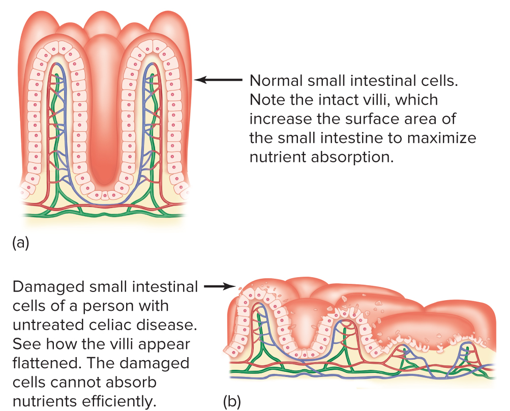 Comparison diagram of normal small intestinal villi, described as tall and finger-like to maximize surface area for nutrient absorption, versus the flattened, damaged villi of untreated celiac disease, which cannot absorb nutrients efficiently.