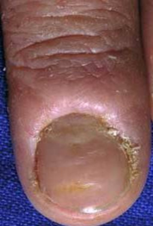 Chronic paronychia with a swollen proximal nail fold, absent cuticle and ridged nail plate