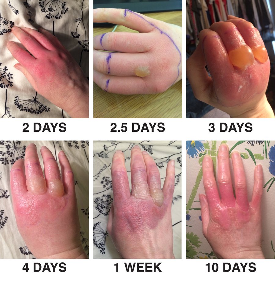 Phytophotodermatitis of the hands after lime juice and sun, photographed from day 2 to day 10