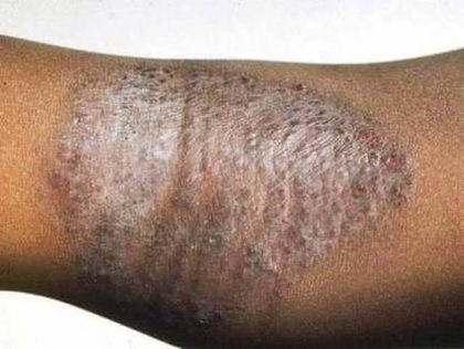 Atopic dermatitis, from the lecture slides