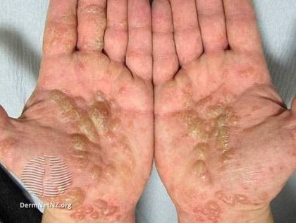 Dyshidrotic eczema, from the lecture slides