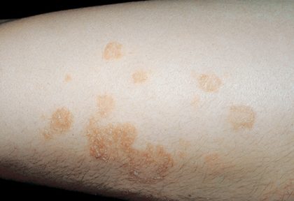 Nummular eczema, from the lecture slides