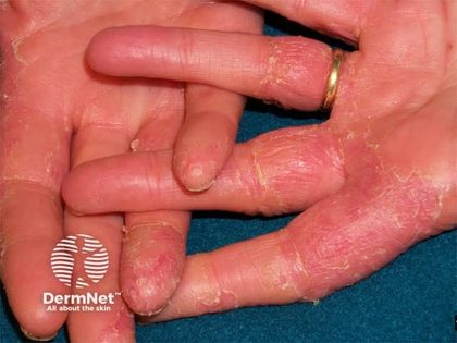 Irritant contact dermatitis, from the lecture slides