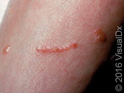 Allergic contact dermatitis, from the lecture slides