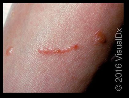 Allergic contact dermatitis &mdash; Sharp geometric margins in the shape of the contactant