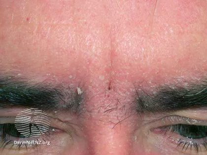 Seborrheic dermatitis, from the lecture slides