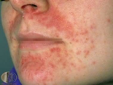 Perioral dermatitis, from the lecture slides