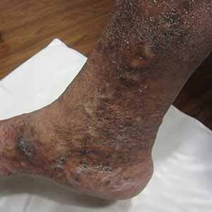 Stasis dermatitis, from the lecture slides