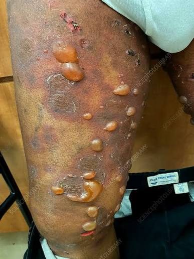 Bullous pemphigoid, from the lecture slides