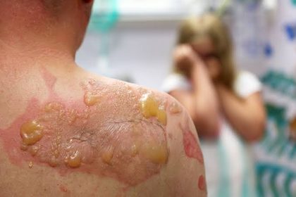 Pemphigus (vulgaris), from the lecture slides