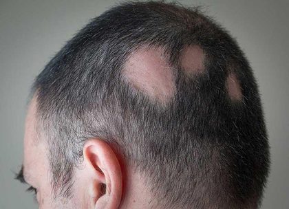 Alopecia areata, from the lecture slides