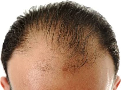 Androgenetic alopecia, from the lecture slides