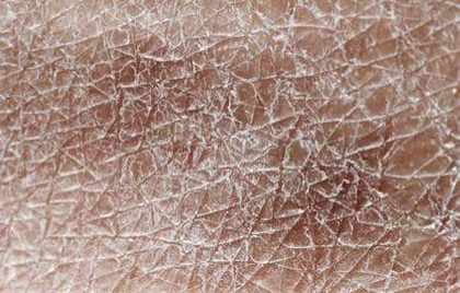 Xeroderma (xerosis), from the lecture slides