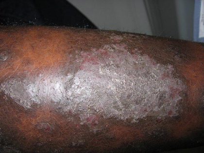 Psoriasis &mdash; plaque &mdash; Sharply marginated plaques with thick silvery scale on extensors