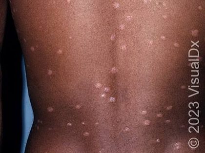 Psoriasis - guttate, from the lecture slides
