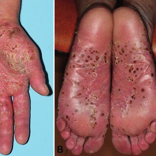 Psoriasis - pustular, from the lecture slides