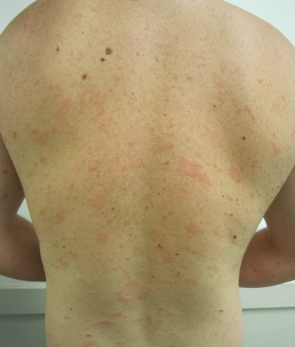 Pityriasis rosea, from the lecture slides