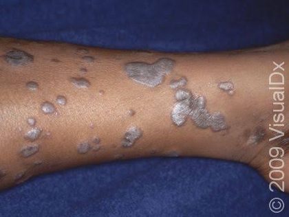 Lichen planus, from the lecture slides