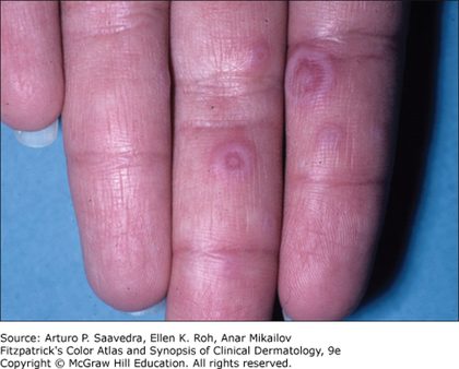 Erythema multiforme, from the lecture slides