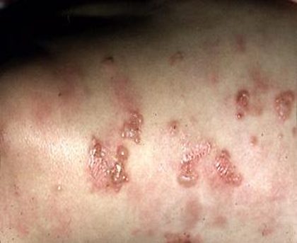 Dermatitis herpetiformis, from the lecture slides