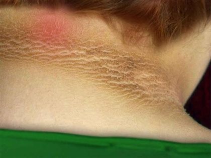 Acanthosis nigricans, from the lecture slides