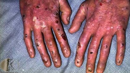 Epidermolysis bullosa, from the lecture slides