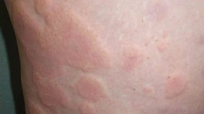Urticaria, from the lecture slides