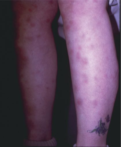 Erythema nodosum, from the lecture slides