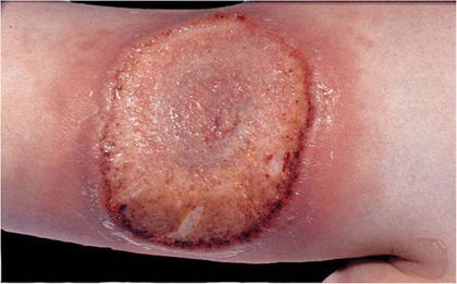 Pyoderma gangrenosum, from the lecture slides