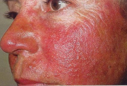Acne rosacea, from the lecture slides